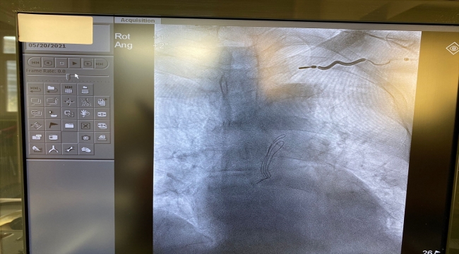 Aydın'da bir hastanın enfeksiyona neden olan kalp pili kablosu, hassas operasyonla çıkarıldı 
