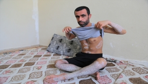 Batman'da, 17 yıldır sedef hastalığıyla mücadele eden genç tedavi olmak istiyor