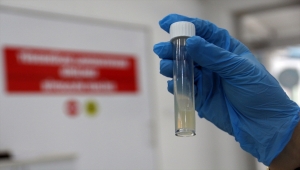 Tüberkülozda erken tanı sürecini hızlandıran yeni yöntem kullanıma sunulacak