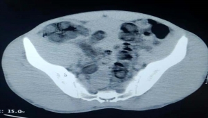 Bitlis'te 2 kişinin midesinden 1 kilo 96 gram eroin çıktı