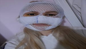 Yüzüne kimyasal madde atılan Sultan, yara izlerini ömür boyu taşıyacak